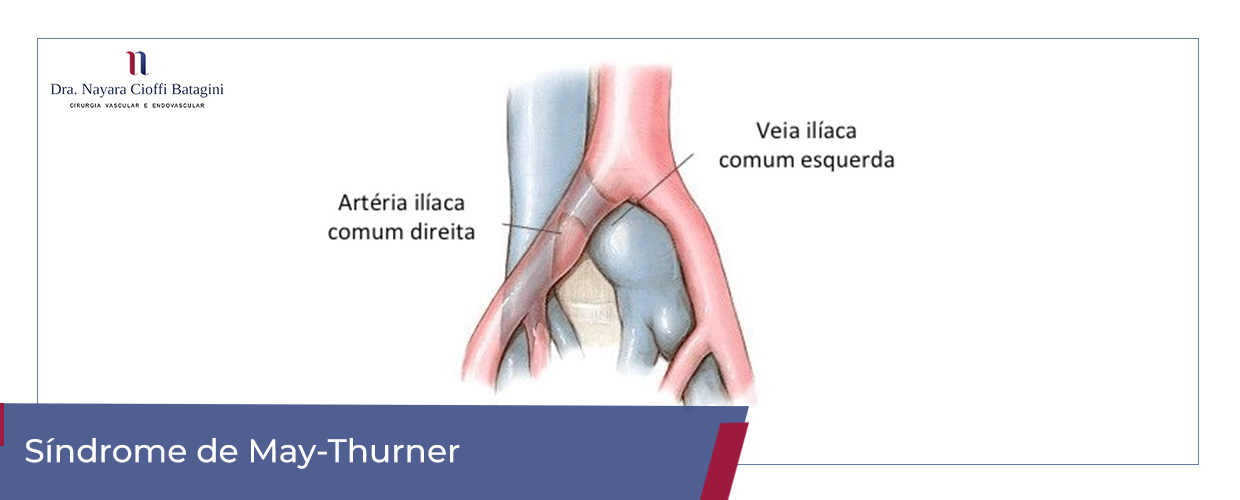 Síndrome de MayThurner/Cockett Entenda a Doença e Saiba Como Tratar