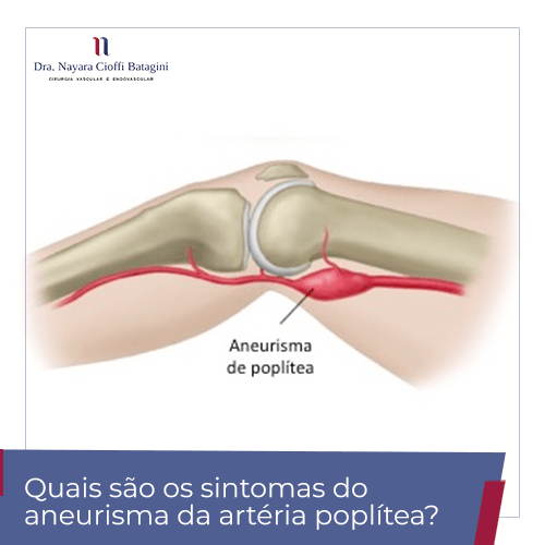 Quais os Sintomas da Aneurisma da Aorta Abdominal?