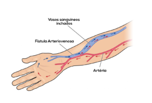 fístula-arteriovenosa