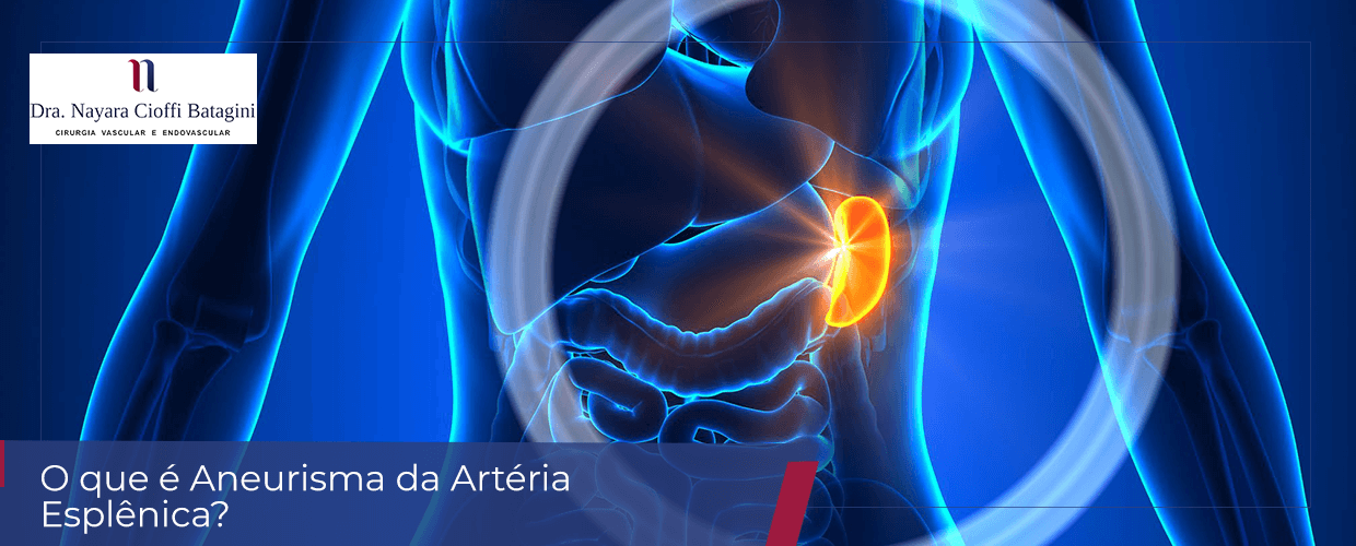 O que é Aneurisma da Artéria Esplênica?