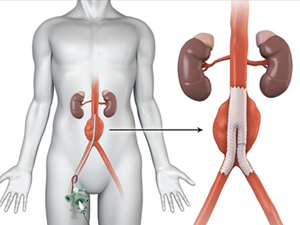 Quais são os sintomas do aneurisma da aorta abdominal?