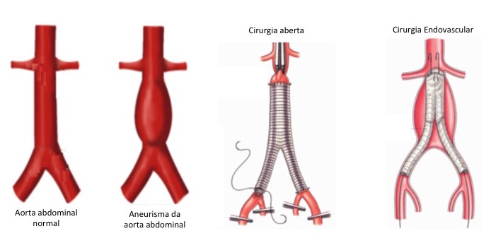 Aneurisma da aorta abdominal tem tratamento?